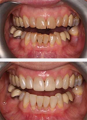 teeth-whitening-1
