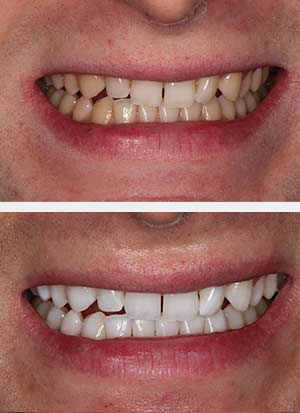 teeth-whitening-2