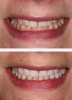 teeth-whitening-3