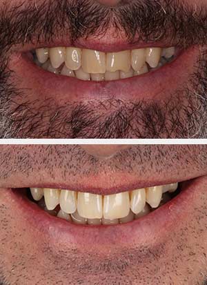 teeth-whitening-4